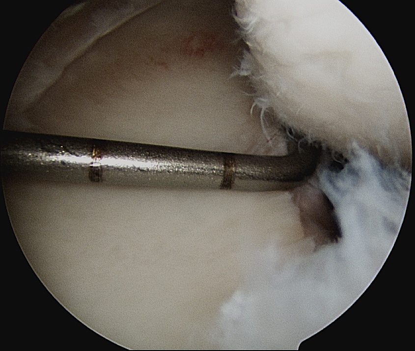 Glenoid Bone Loss Measurement 2